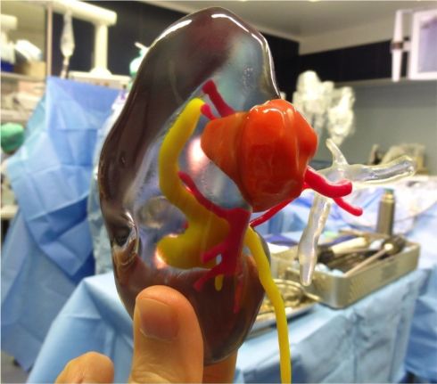 A 3D model of kidney before operation